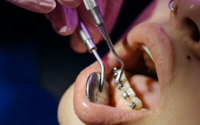 Descubre Cómo Enderezar Tus Dientes sin Metal