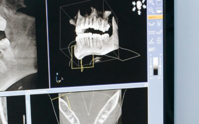 Descubriendo el avance mandibular de Smartee