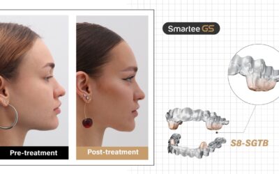 Descifrando la ciencia detrás de la tecnología de reposicionamiento mandibular de Smartee